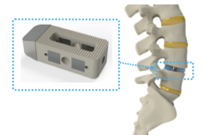 Intelligent Implants 筹集了 870 万美元来帮助您长出脊柱